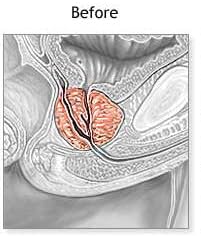 Pulean Formula - Natural Enlarged Prostate Support, Winner of 5 Awards. 240 Tablets