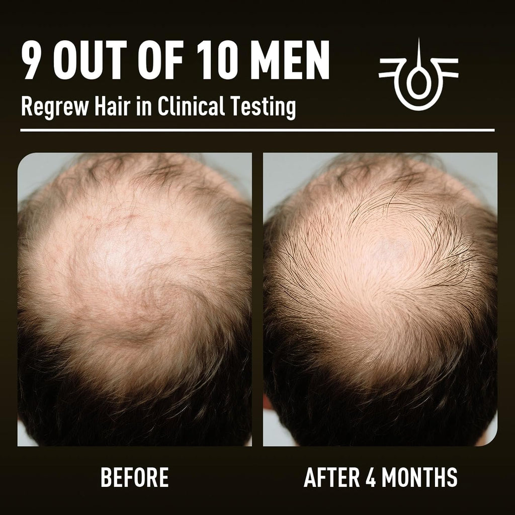 Minoxidil Hair Growth With Biotin 5%: Minoxidil for Men and Women - Hair Growth Treatment Supports Thicker and Fuller Beard & Hair(4 Pack 8Oz For 8 Month Supply)