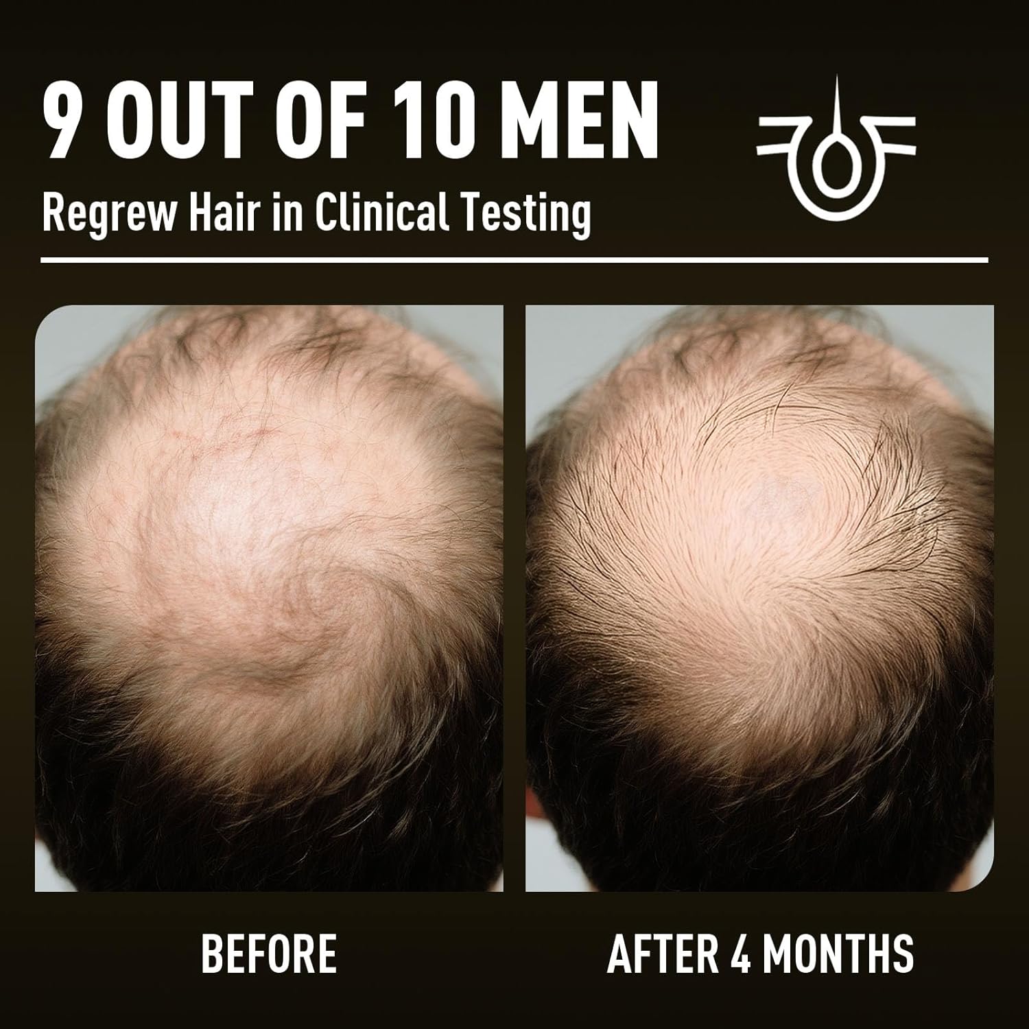 Minoxidil Hair Growth With Biotin 5%: Minoxidil for Men and Women - Hair Growth Treatment Supports Thicker and Fuller Beard & Hair(4 Pack 8Oz For 8 Month Supply)